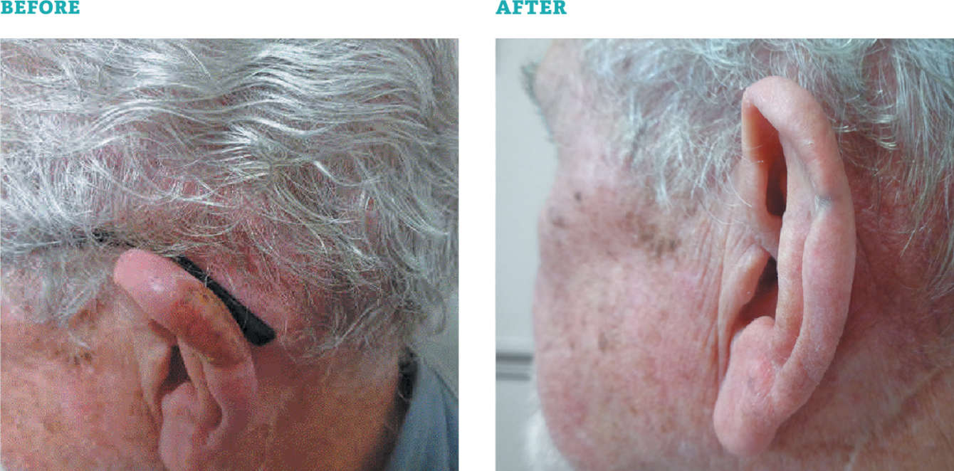 Electron Therapy for Skin Cancer and Dermatology IntraOp